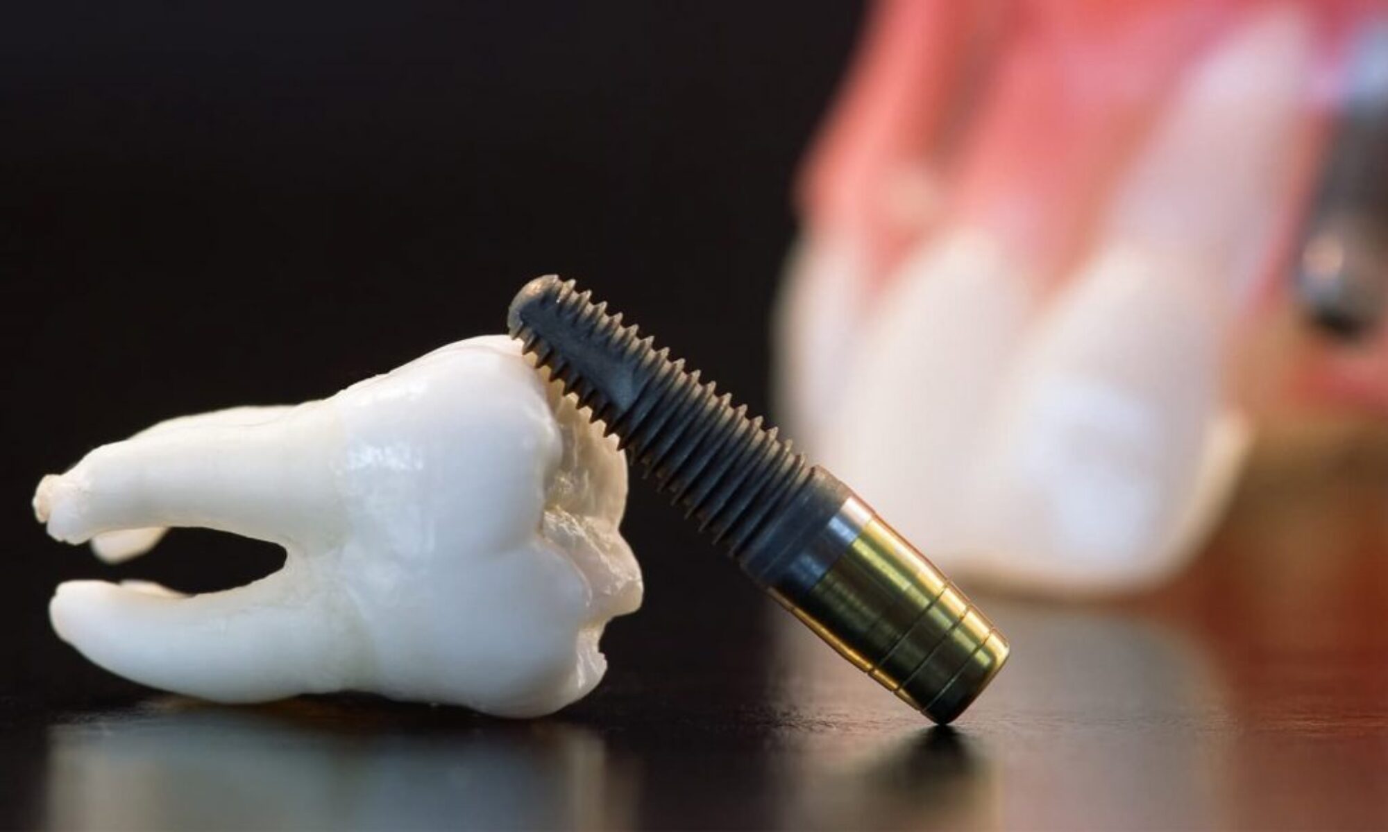 A close-up view of a dental implant being carefully placed by a skilled dentist at Beauty Smile Dental Studio in Tijuana, highlighting the precision and advanced technology used in the procedure.