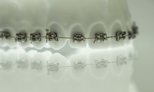 Braces And Orthodontics